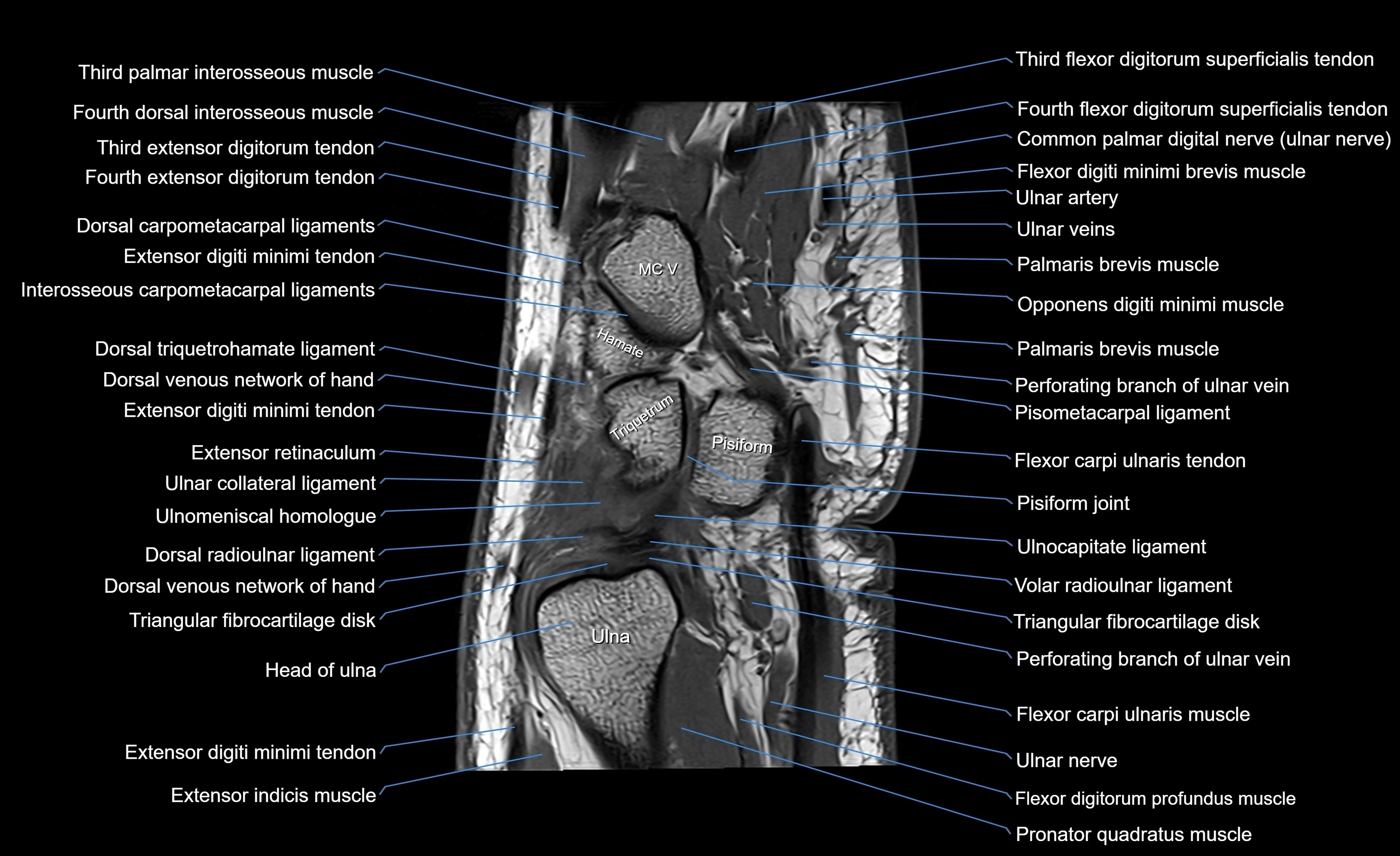 MRI wrist sagittal cross sectional anatomy 3T  radiology  image-img-00001-00020.webp